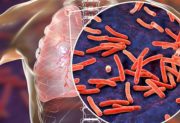 Tuberkulosis: Ancaman Global yang Kembali Menjadi Pembunuh Utama