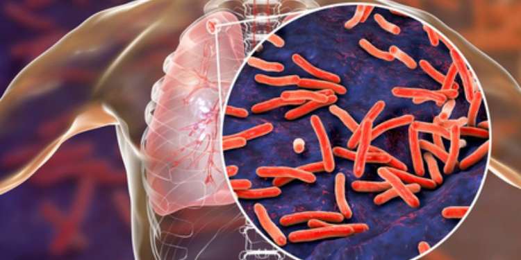 Tuberkulosis: Ancaman Global yang Kembali Menjadi Pembunuh Utama